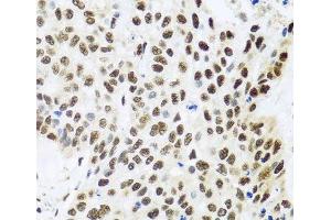Immunohistochemistry of paraffin-embedded Human lung cancer using FUBP1 Polyclonal Antibody at dilution of 1:100 (40x lens). (FUBP1 antibody)