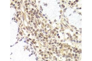 Immunohistochemistry of paraffin-embedded Human adenomyosis using PHC1 Polyclonal Antibody at dilution of 1:200 (40x lens). (PHC1 antibody)