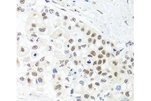 Immunohistochemistry of paraffin-embedded Human lung cancer using TRMT1 Polyclonal Antibody at dilution of 1:100 (40x lens).
