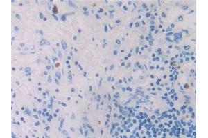Detection of MIP4a in Human Lung cancer Tissue using Polyclonal Antibody to Macrophage Inflammatory Protein 4 Alpha (MIP4a) (CCL26 antibody  (AA 24-94))