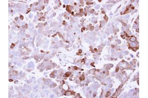 IHC-P Image Immunohistochemical analysis of paraffin-embedded OVCAR3 xenograft, using AKR1B10, antibody at 1:500 dilution. (AKR1B10 antibody)