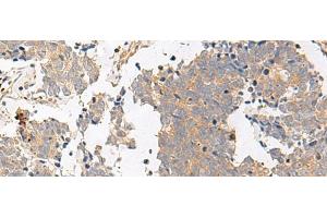 Immunohistochemistry of paraffin-embedded Human lung cancer tissue using GPR153 Polyclonal Antibody at dilution of 1:40(x200) (GPR153 antibody)
