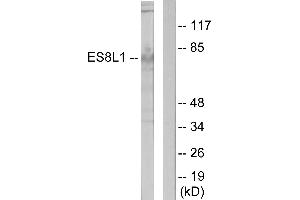 Immunohistochemistry analysis of paraffin-embedded human colon carcinoma tissue using ES8L1 antibody. (EPS8-Like 1 antibody)