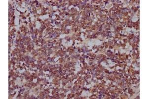 IHC image of ABIN7168099 diluted at 1:200 and staining in paraffin-embedded human lung cancer performed on a Leica BondTM system. (DROSHA antibody  (AA 1-100))
