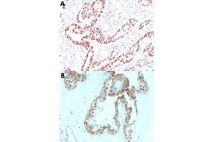 Immunohistochemical staining (Formalin-fixed paraffin-embedded sections) of human colon carcinoma (A) and human prostate carcinoma (B) with CDKN1C monoclonal antibody, clone KIP2/880 . (CDKN1C antibody)