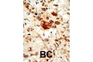 Formalin-fixed and paraffin-embedded human cancer tissue reacted with the primary antibody, which was peroxidase-conjugated to the secondary antibody, followed by AEC staining. (EPHA1 antibody  (C-Term))