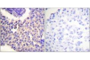 Immunohistochemistry analysis of paraffin-embedded human breast carcinoma, using Arrestin 1 (Phospho-Ser412) Antibody. (SAG antibody  (pSer412))