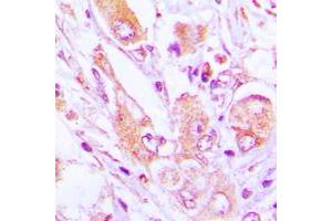 Immunohistochemical analysis of MRPS35 staining in human lung cancer formalin fixed paraffin embedded tissue section. (MRPS35 antibody  (Center))