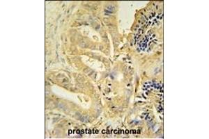 TLL1 antibody (C-term) (ABIN654712 and ABIN2844401) immunohistochemistry analysis in formalin fixed and paraffin embedded human prostate carcinoma followed by peroxidase conjugation of the secondary antibody and DAB staining. (TLL1 antibody  (C-Term))