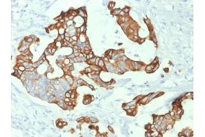 Formalin-fixed, paraffin-embedded human Colon Carcinoma stained with Cytokeratin 20 (KRT20) Mouse Monoclonal Antibody (KRT20/1992). (KRT20 antibody  (AA 196-323))