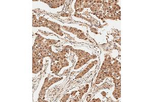 Immunohistochemical analysis of paraffin-embedded Human breast carcinoma tissue using (ABIN388039 and ABIN2845540) performed on the Leica® BOND RXm.
