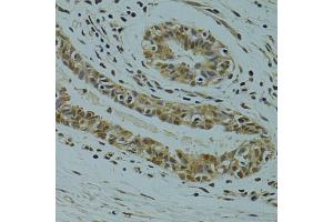 Immunohistochemistry of paraffin-embedded human breast cancer using RSRC1 antibody (ABIN5974341) at dilution of 1/100 (40x lens). (RSRC1 antibody)