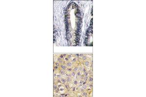 (TOP)Formalin-fixed and paraffin-embedded human breast carcinoma reacted with EphB2 Antibody (C-term), which was peroxidase-conjugated to the secondary antibody, followed by DAB staining. (EPH Receptor B2 antibody  (C-Term))