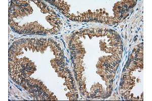 Immunohistochemical staining of paraffin-embedded Carcinoma of Human liver tissue using anti-RAB17 mouse monoclonal antibody. (RAB17 antibody)
