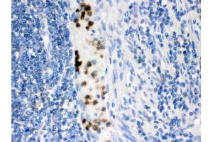 Cardiac FABP was detected in paraffin-embedded sections of human intestinal cancer tissues using rabbit anti- Cardiac FABP Antigen Affinity purified polyclonal antibody (Catalog # ) at 1 ? (FABP3 antibody  (C-Term))
