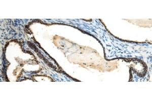 Immunohistochemistry of paraffin-embedded Human prost at e cancer tissue using SUV39H2 Polyclonal Antibody at dilution of 1:70(x200) (SUV39H2 antibody)