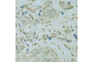 Immunohistochemistry of paraffin-embedded human breast cancer using SAFB antibody (ABIN5975793) at dilution of 1/100 (40x lens). (SAFB antibody)