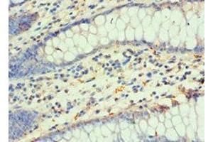 Immunohistochemistry of paraffin-embedded human colon cancer using ABIN7155678 at dilution of 1:100 (DLX3 antibody  (AA 1-120))
