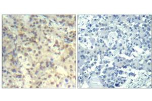 Immunohistochemical analysis of paraffin-embedded human lung carcinoma tissue using cofilin1 (phospho-Tyr139) Antibody (E011506). (Cofilin antibody  (pTyr139))