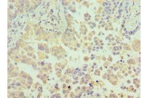 Immunohistochemistry of paraffin-embedded human lung cancer using ABIN7154967 at dilution of 1:100 (N6AMT1 antibody  (AA 1-186))