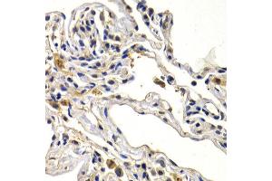 Immunohistochemistry of paraffin-embedded human lung cancer using WNT3A antibody at dilution of 1:200 (400x lens).