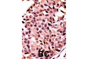 Formalin-fixed and paraffin-embedded human cancer tissue reacted with the primary antibody, which was peroxidase-conjugated to the secondary antibody, followed by AEC staining. (PPP3CC antibody  (N-Term))