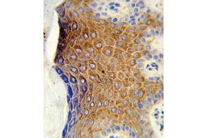 Formalin-fixed and paraffin-embedded human skin tissue reacted with GALNT3 Antibody (Center), which was peroxidase-conjugated to the secondary antibody, followed by DAB staining. (GALNT3 antibody  (AA 454-481))