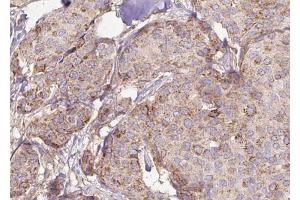 ABIN6272946 at 1/100 staining Human breast cancer tissue by IHC-P.