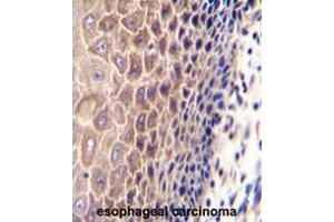 CCDC97 Antibody (C-term) immunohistochemistry analysis in formalin fixed and paraffin embedded human esophageal carcinoma followed by peroxidase conjugation of the secondary antibody and DAB staining. (CCDC97 antibody  (C-Term))