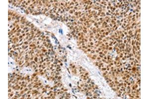 The image on the left is immunohistochemistry of paraffin-embedded Human lung cancer tissue using ABIN7129916(IRF6 Antibody) at dilution 1/50, on the right is treated with fusion protein. (IRF6 antibody)