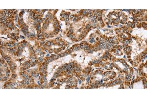 Immunohistochemistry of paraffin-embedded Human thyroid cancer using PPOX Polyclonal Antibody at dilution of 1:40 (PPOX antibody)