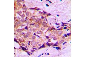 Immunohistochemical analysis of DNAL4 staining in human breast cancer formalin fixed paraffin embedded tissue section. (DNAL4 antibody  (N-Term))