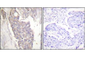Immunohistochemistry analysis of paraffin-embedded human breast carcinoma tissue using Fas antibody. (FAS antibody)