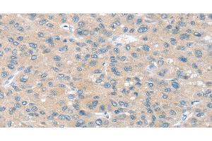 Immunohistochemistry of paraffin-embedded Human liver cancer using SLIT2 Polyclonal Antibody at dilution of 1:30 (SLIT2 antibody)