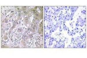 Immunohistochemistry analysis of paraffin-embedded human liver carcinoma tissue using ACOT12 antibody. (ACOT12 antibody)