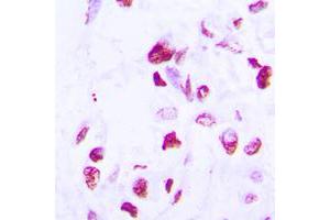 Immunohistochemical analysis of C/EBP delta/epsilon staining in human lung cancer formalin fixed paraffin embedded tissue section. (C/EBP delta/epsilon (C-Term) antibody)