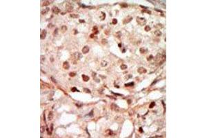 Formalin-fixed and paraffin-embedded human cancer tissue reacted with the primary antibody, which was peroxidase-conjugated to the secondary antibody, followed by DAB staining. (CDK10 antibody  (N-Term))