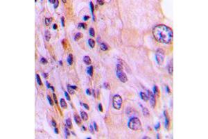 Immunohistochemical analysis of Rhotekin staining in human lung cancer formalin fixed paraffin embedded tissue section. (Rhotekin antibody  (Center))