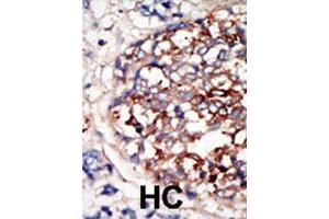 Formalin-fixed and paraffin-embedded human hepatocellular carcinoma tissue reacted with DYRK1B polyclonal antibody  , which was peroxidase-conjugated to the secondary antibody, followed by DAB staining. (DYRK1B antibody  (C-Term))