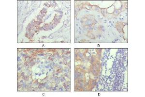 Immunohistochemical analysis of paraffin-embedded human ovary carcinoma (A), kidney carcinoma (B), lung carcinoma (C) and breast carcinoma (D), showing cytoplasmic and membrane localization with DAB staining using ALCAM mouse mAb. (CD166 antibody  (AA 405-524))