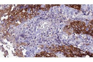 ABIN6277924 at 1/100 staining Human Head and neck cancer tissue by IHC-P. (SLC39A8 antibody  (Internal Region))