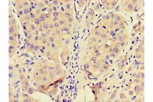 Immunohistochemistry of paraffin-embedded human liver cancer using ABIN7144950 at dilution of 1:100 (PFKL antibody  (AA 229-479))