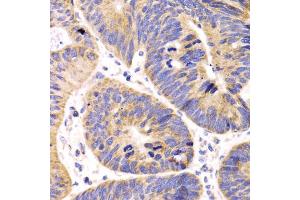 Immunohistochemistry of paraffin-embedded human colon carcinoma using HMGCL antibody (ABIN5975709) at dilution of 1/100 (40x lens). (HMGCL antibody)