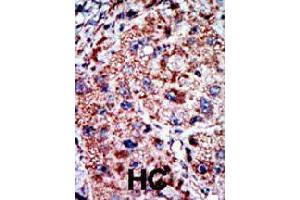 Formalin-fixed and paraffin-embedded human hepatocellular carcinoma tissue reacted with PFKL polyclonal antibody  , which was peroxidase-conjugated to the secondary antibody, followed by AEC staining. (PFKL antibody  (C-Term))