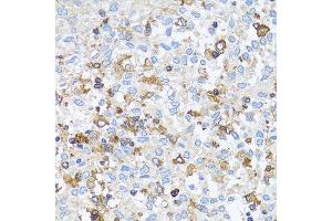 Immunohistochemistry of paraffin-embedded human lung cancer using ACTR2 antibody. (ACTR2 antibody  (AA 1-160))