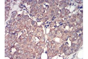 Immunohistochemical analysis of paraffin-embedded breast cancer tissues using IRAK3 mouse mAb with DAB staining. (IRAK3 antibody  (AA 454-596))