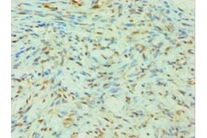 Immunohistochemistry of paraffin-embedded human breast cancer using ABIN7144142 at dilution of 1:100 (SLC4A2 antibody  (AA 95-245))