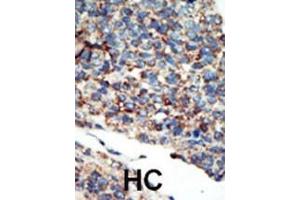 Formalin-fixed and paraffin-embedded human cancer tissue reacted with the primary antibody, which was peroxidase-conjugated to the secondary antibody, followed by AEC staining. (PI3KC2G antibody  (N-Term))