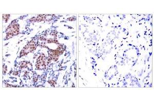 Immunohistochemical analysis of paraffin-embedded human breast carcinoma tissue using Elk-1 (phospho-Ser383) antibody (E011004). (ELK1 antibody  (pSer383))