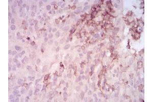 Immunohistochemical analysis of paraffin-embedded ovarian cancer tissues using MMP14 mouse mAb with DAB staining.